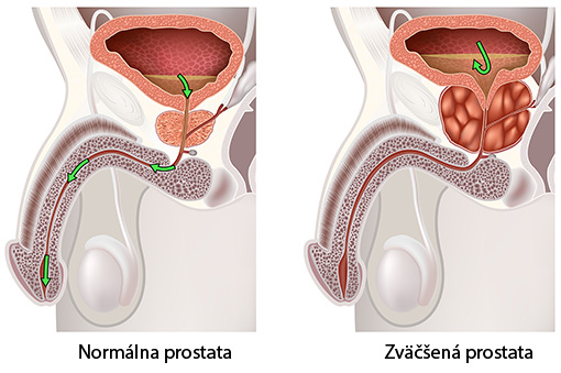 Ilustrácia zväčšenia prostaty - benígna hypertrofia prostaty